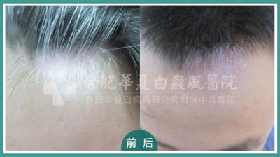 头发白斑.png